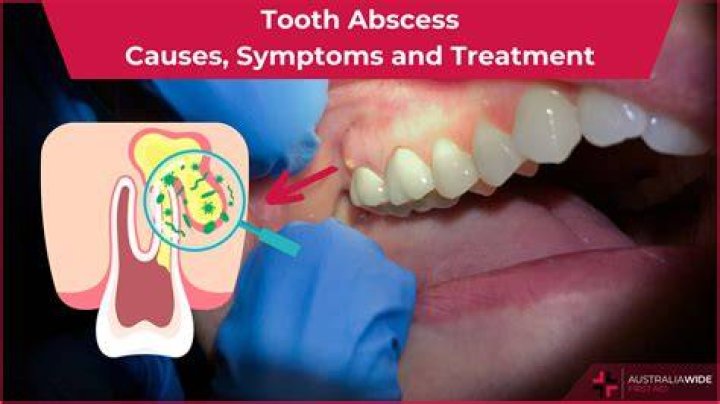 Can a tooth abscess affect your nose?