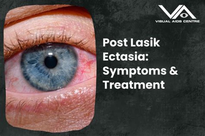 Can LASIK cause corneal ectasia?