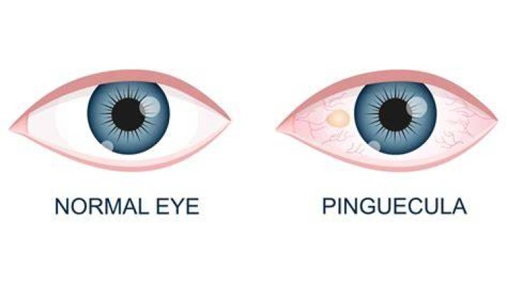 Does a pinguecula go away?