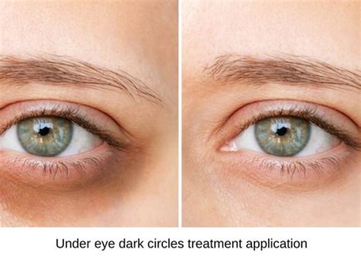 How can I remove dark circle under my eyes?
