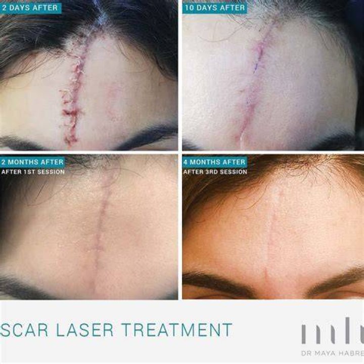 How do you cover dark scars?