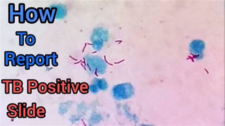 How do you identify a sputum positive case in TB?