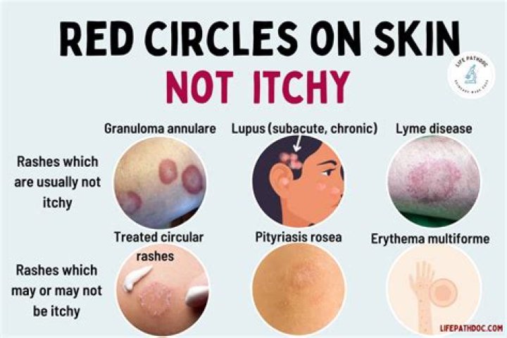 What are round circles on skin?
