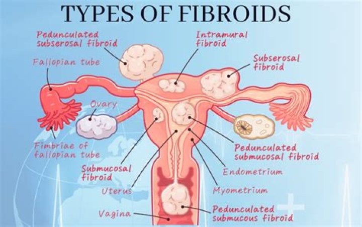 What causes cysts and fibroids?