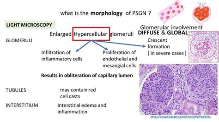 What causes PSGN?