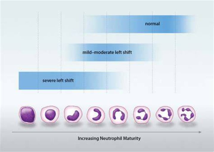 What does a left shift in neutrophils mean?