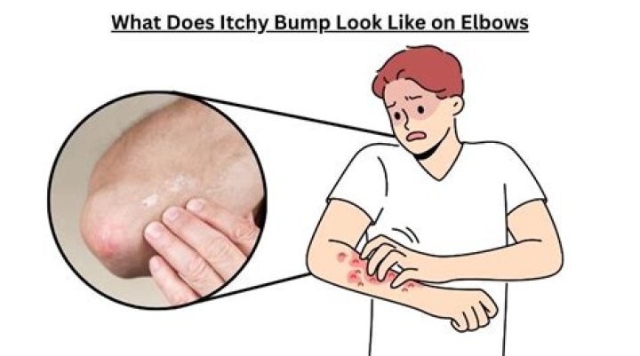 What does it mean when your elbows are itchy?