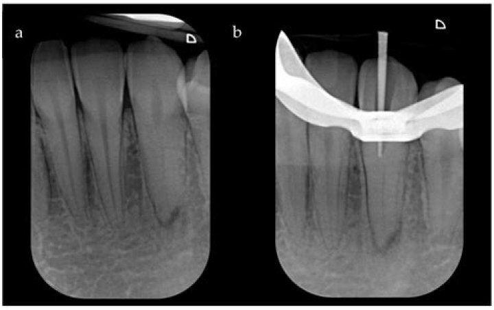 What is a calcified fragment?