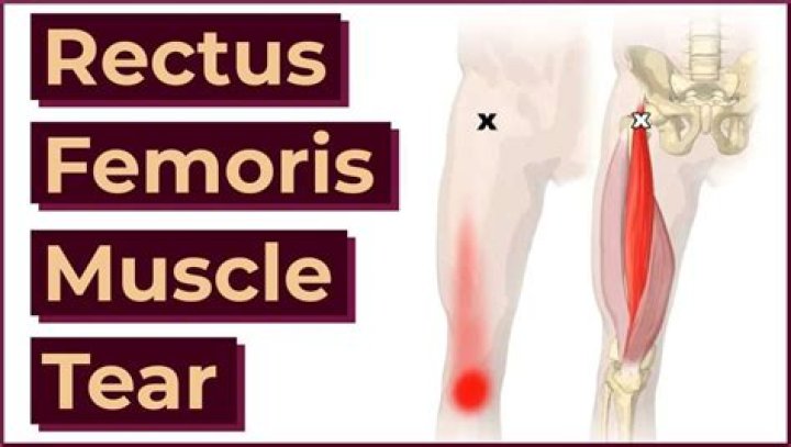 What is a rectus femoris strain?