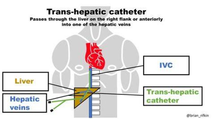 What is a transhepatic catheter?