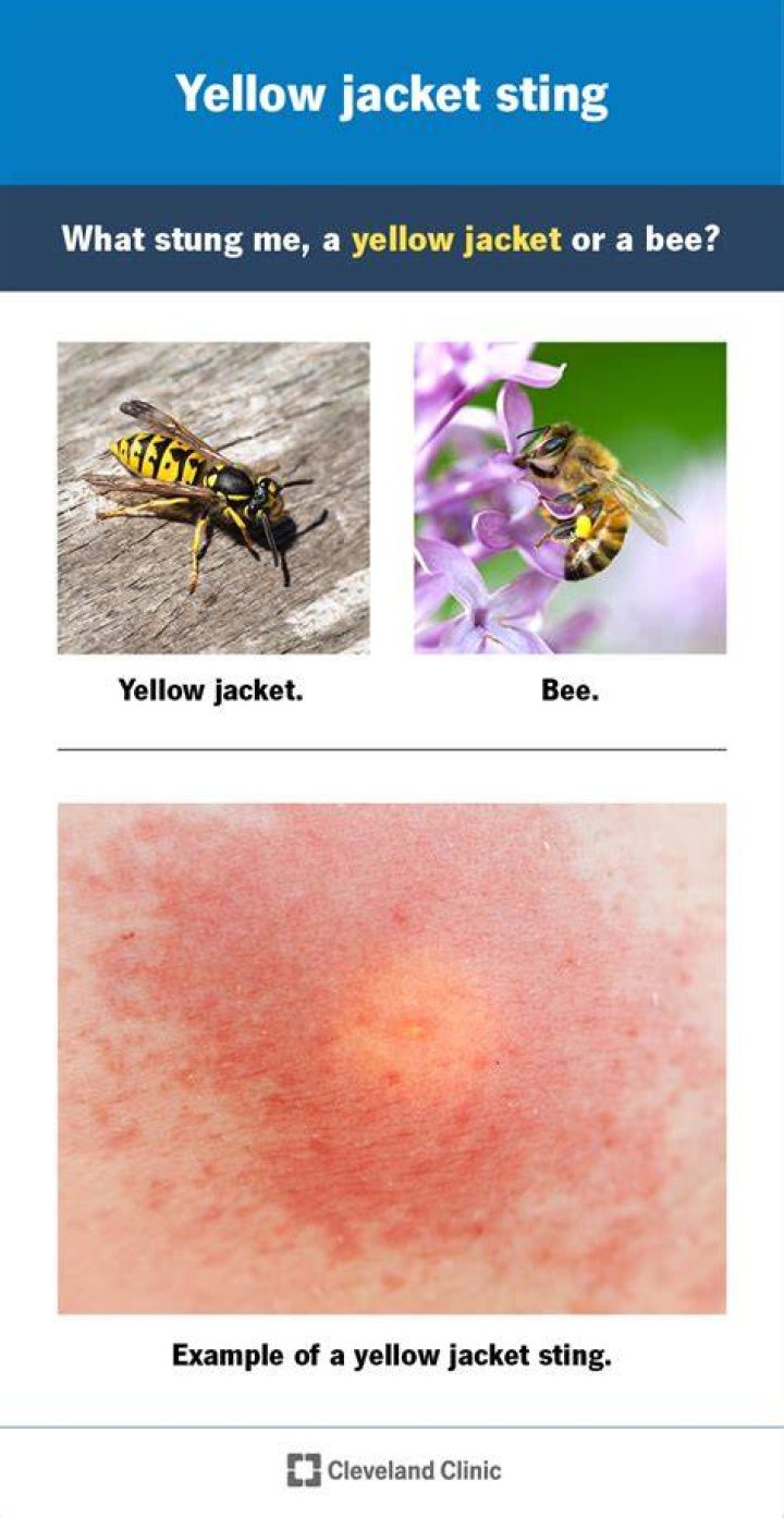 When should I be concerned about a yellow jacket sting?