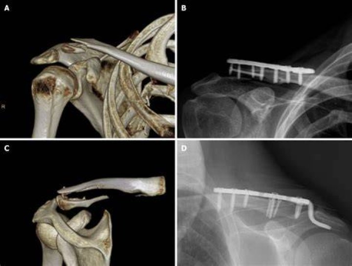 Which clavicle fracture requires surgery?