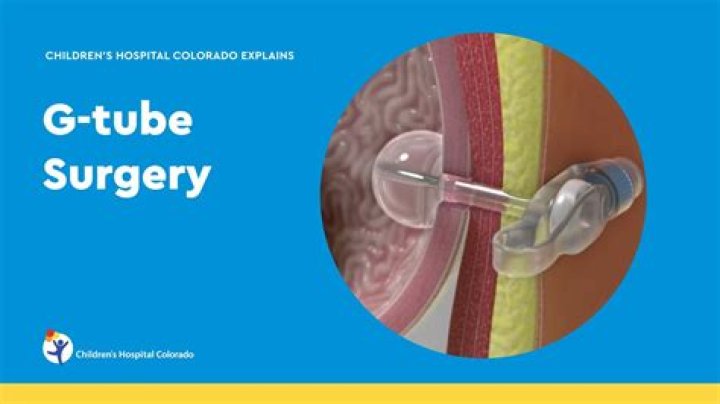 Why do babies get G tubes?