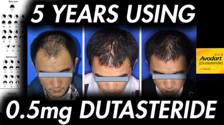Will Avodart regrow hair?